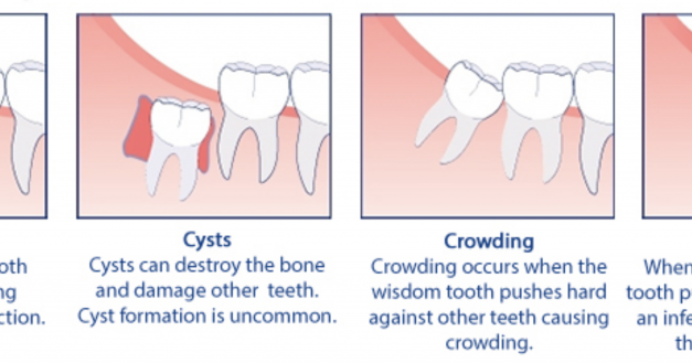 Wisdom Tooth Problems