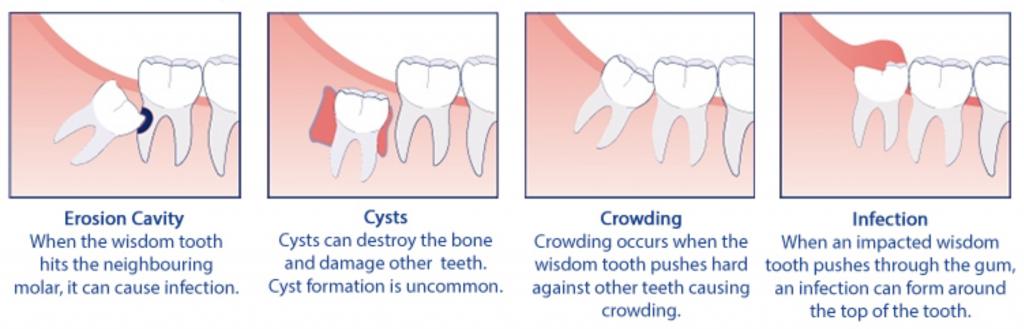 Wisdom Tooth Problems